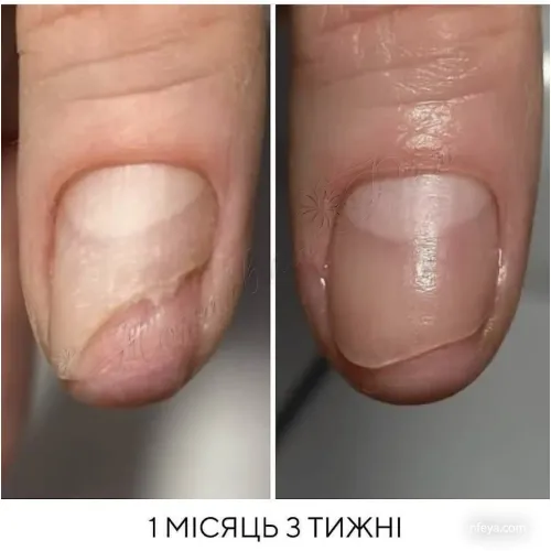 NAILSOFTHEDAY OniStop Олійка для лікування оніхолізісу, 15 мл